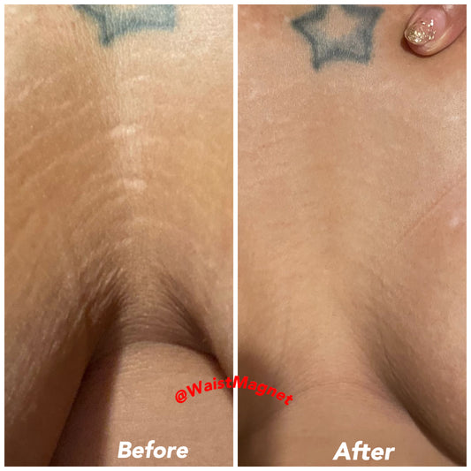 Stretch Mark Removal Cream