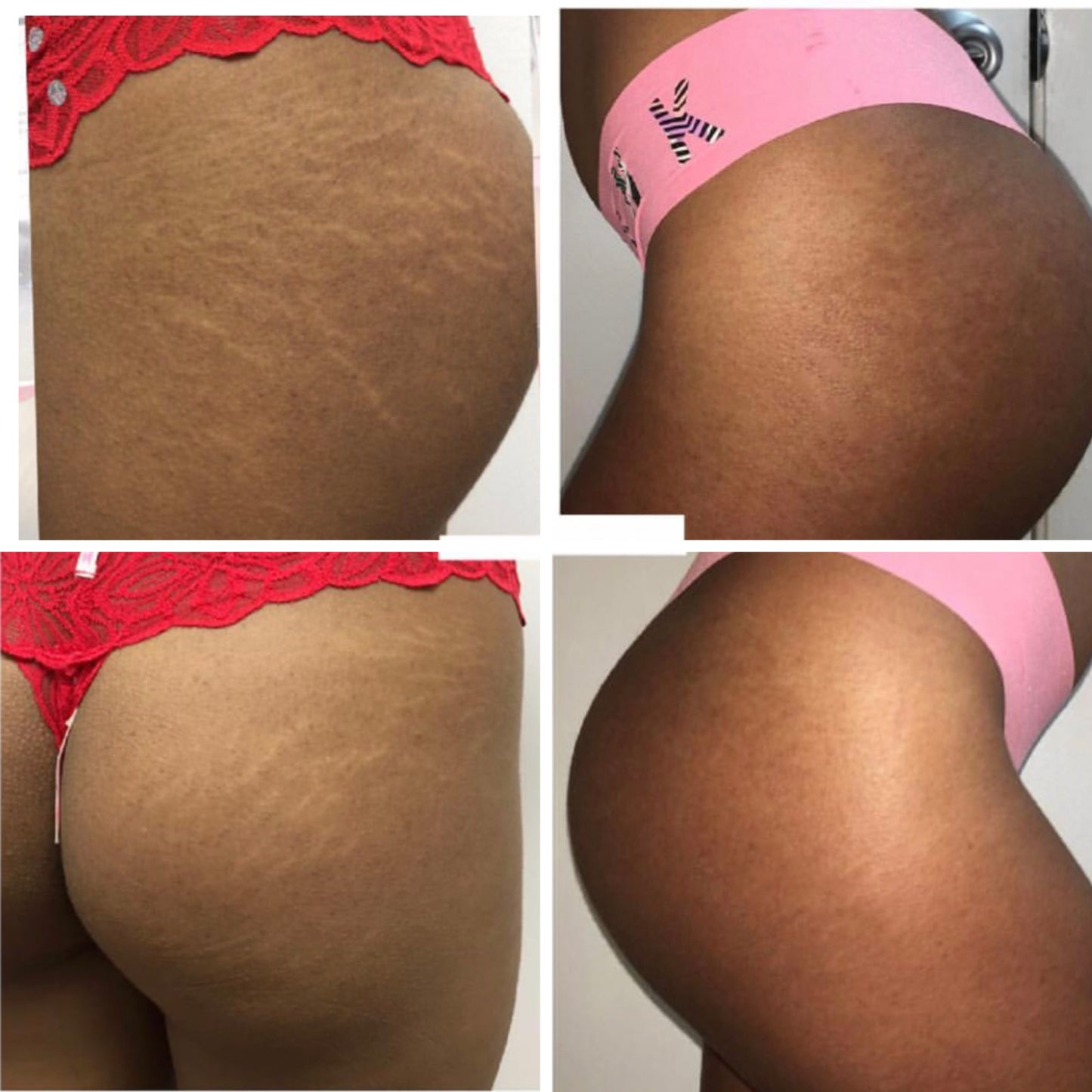 Cellulite & Stretch Mark Removal Double Pack!